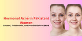 Hormonal Acne in Pakistani Women: Causes, Treatments, and Prevention